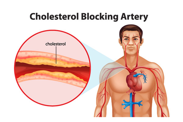 Bergamot reduces LDL cholesterol