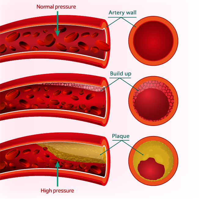 Atherosclerosis