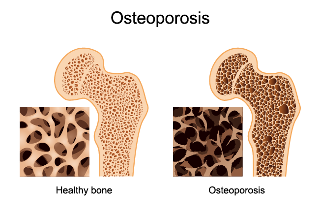 MK-7 (Vitamin K2) Reduced Bone Loss in Postmenopausal Women | WhatSuppBox