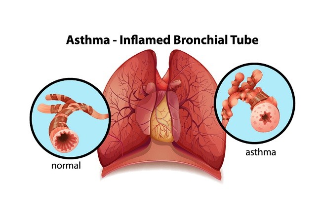 Quercetin Bronchodilating Effect in Asthma