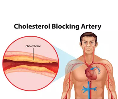 Cholesterol