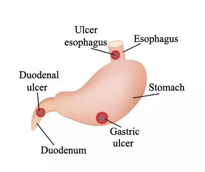 Ulcers