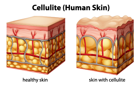 cellulite product category image